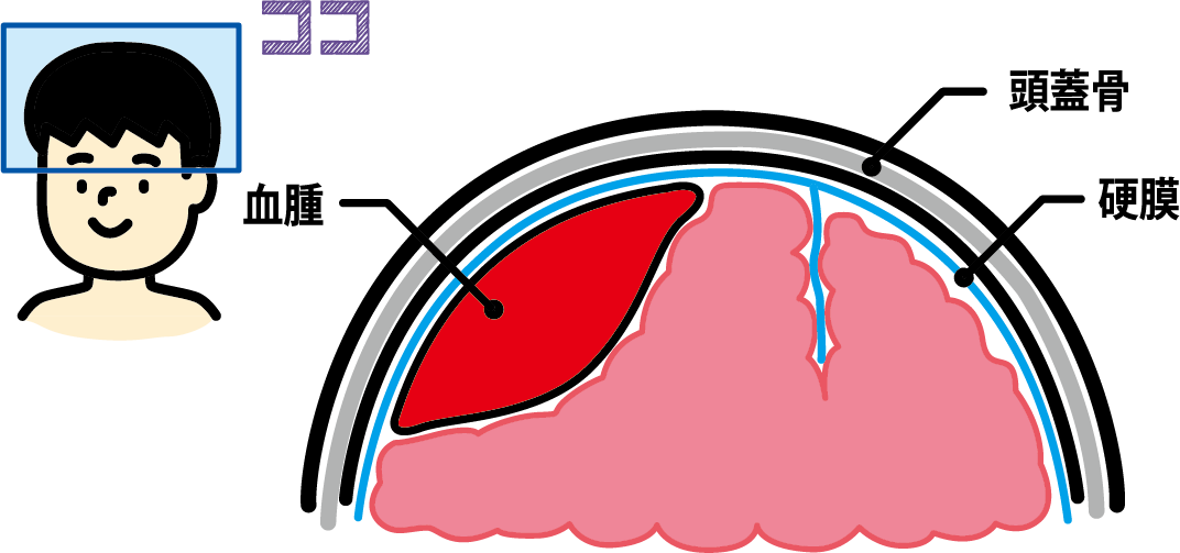 外側から順に頭蓋骨、硬膜、血種